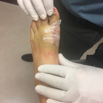 Vittorio Lagana, DPM - 4.5 days post op - Podiatrists Near Me - Salinas, California Vittorio Lagana, DPM - 4.5 days post op - Podiatrists Near Me - Salinas, California