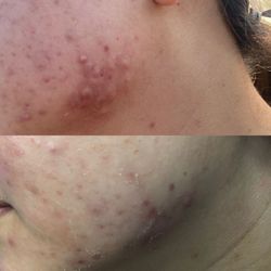 Great Skin Rules - 3 days post peel