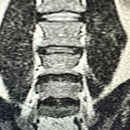 My two lumbar discs completely gone My two lumbar discs completely gone