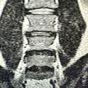 Rasouli Spine - My two lumbar discs completely gone - Spine Surgeons Near Me - Beverly Hills, California Rasouli Spine - My two lumbar discs completely gone - Spine Surgeons Near Me - Beverly Hills, California