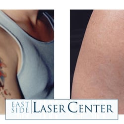 East Side Laser Center - Laser hair removal
tattoo removal
traumatic scar removal
acne scar removal
laser skin rejuvenation
fraxel
laser scar removal
...