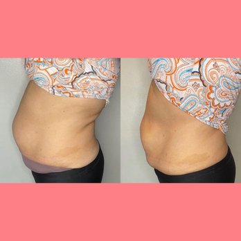 Lenué Sculpting - Non-invasive skin tightening. - Body Contouring Near Me Lenué Sculpting - Non-invasive skin tightening. - Body Contouring Near Me