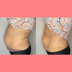 Lenué Sculpting - Non-invasive skin tightening.