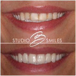 Studio B Smiles - 10 upper veneers to replace old bonding