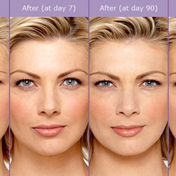 Aesthetic Eye - Botox