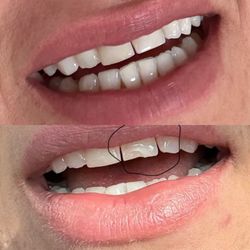 Dentistry For Children - Before and after photo