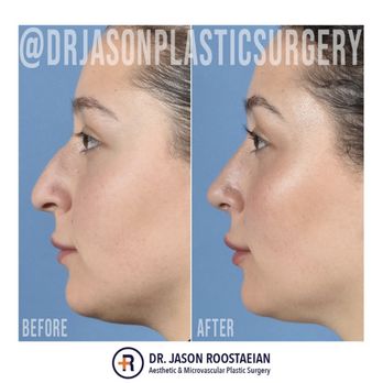 Jason Roostaeian, MD - Side profile - Cosmetic Surgeons Near Me - Los Angeles, California Jason Roostaeian, MD - Side profile - Cosmetic Surgeons Near Me - Los Angeles, California