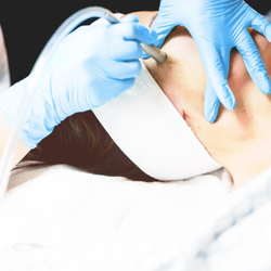 Skin And - Mircrodermabrasion