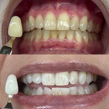 The Coco Blanc Teeth Whitening - Before & After - Teeth Whitening Near Me - Whittier, California The Coco Blanc Teeth Whitening - Before & After - Teeth Whitening Near Me - Whittier, California