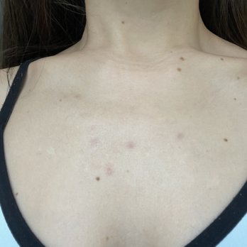 Solutions Skin Care By Kimberly - After: acne scarring from hormonal cystic acne, improving with time - Skin Care Near Me - Costa Mesa, California