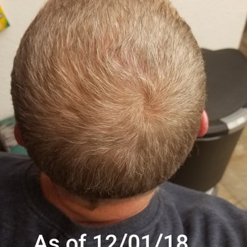Allure MD - 4. Cant even tell where the divot was originally. Picture of back of head as of December. - Plastic Surgeons Near Me - Newport Beach, California Allure MD - 4. Cant even tell where the divot was originally. Picture of back of head as of December. - Plastic Surgeons Near Me - Newport Beach, California