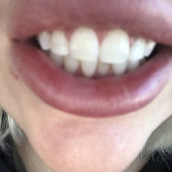 Vivid Smiles Express - After - Teeth Whitening Near Me - Beverly Hills, California Vivid Smiles Express - After - Teeth Whitening Near Me - Beverly Hills, California