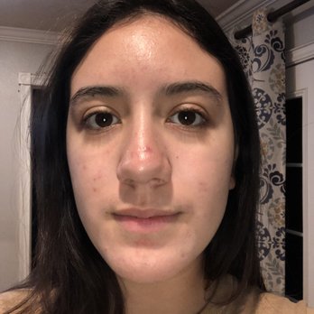 Pure Skin Clinic - This is a current picture. I also just had a chemical peel done today - Skin Care Near Me - Brea, California Pure Skin Clinic - This is a current picture. I also just had a chemical peel done today - Skin Care Near Me - Brea, California