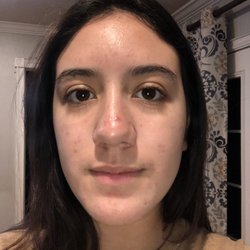 Pure Skin Clinic - This is a current picture. I also just had a chemical peel done today