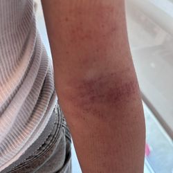 Keith R Brookenthal, MD - Bruising