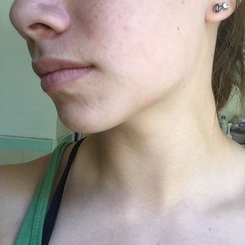 Mehta Plastic Surgery - After less than one year of visiting Jill - Cosmetic Surgeons Near Me - Menlo Park, California
