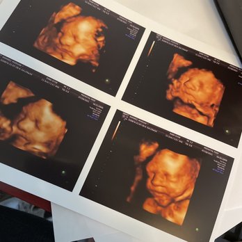 Prenatal Peek - Ultrasound Imaging Centers Near Me - Santa Rosa, California Prenatal Peek - Ultrasound Imaging Centers Near Me - Santa Rosa, California
