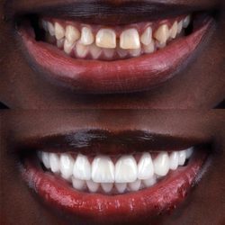 Dental Design Smile Miami