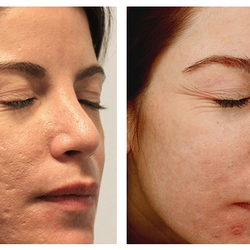 Dermatology & Laser Surgery Center - Scar Before & After