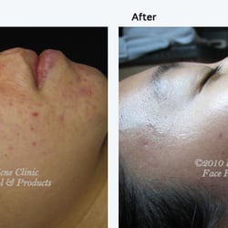 Skin and Acne Specialist - Inflamed Acne before and after