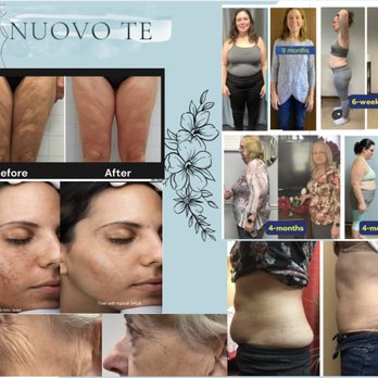 Nuovo Te - Medical Grade Facials with plant-based stem cells, Cryo T Shock & Sentient cellulite & fat reduction, Tixel skin resurfacing, Weight Loss! - Weight Loss Centers Near Me - Janesville, Wisconsin Nuovo Te - Medical Grade Facials with plant-based stem cells, Cryo T Shock & Sentient cellulite & fat reduction, Tixel skin resurfacing, Weight Loss! - Weight Loss Centers Near Me - Janesville, Wisconsin
