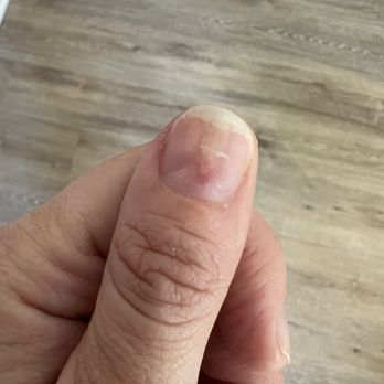 Vogue Nail Spa - Thumb infection from two days after my nails were done - Nail Salons Near Me - Indianapolis, Indiana Vogue Nail Spa - Thumb infection from two days after my nails were done - Nail Salons Near Me - Indianapolis, Indiana