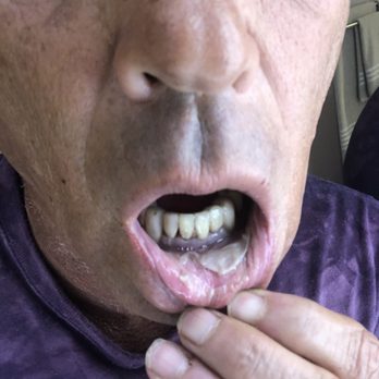 Ronald E Hawk, DDS - Definitely not a canker sore as Dr. Hawk tried to claim. The skin feel off less then 24 hours after a routine procedure with Dr. Hawk. - Cosmetic Dentists Near Me - Boca Raton, Florida