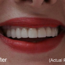 Peninsula Dental Care - After Gum Surgery and Cosmetic Crowns