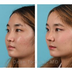 Dean Toriumi, MD - She is doing well two years postoperative with excellent nasal tip projection and good dorsal contours. Her nasal function is excellent.