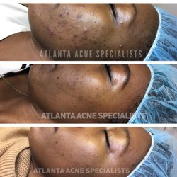 Atlanta Acne Specialists - Before, 16 weeks and 6 months.