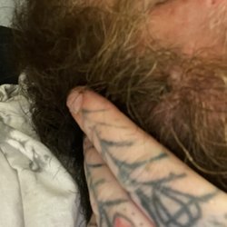 Cooper Urgent Care - Shingles on right side of chin