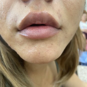 LaserAway - My lip fillers - Tattoo Removal Near Me - Brea, California LaserAway - My lip fillers - Tattoo Removal Near Me - Brea, California