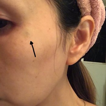 ME Medspa - Bruise after getting Botox - Medical Spas Near Me - Monterey Park, California ME Medspa - Bruise after getting Botox - Medical Spas Near Me - Monterey Park, California