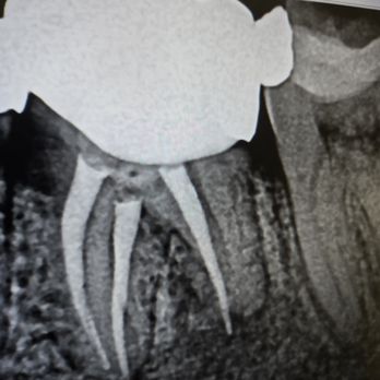 Craig D Johnson, DDS , MS, PC - Avoid this place, missed a canal and refused to do anything about it besides charging me more for a different procedure costing more money - Endodontists Near Me - Portland, Oregon Craig D Johnson, DDS , MS, PC - Avoid this place, missed a canal and refused to do anything about it besides charging me more for a different procedure costing more money - Endodontists Near Me - Portland, Oregon