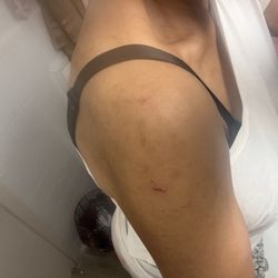 Madison Hospital - The doctor told me this was healing when it just broke out.