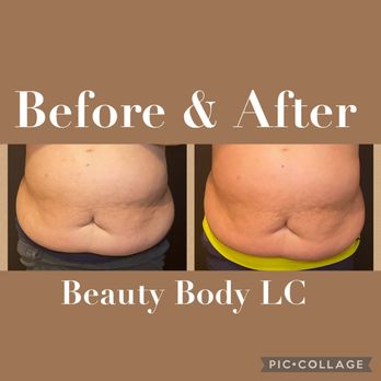 Beauty Body LC - Before and after of a Lipo Cavitation session - Skin Care Near Me - Grapevine, Texas