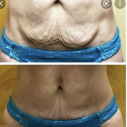 Precise Body Sculpting