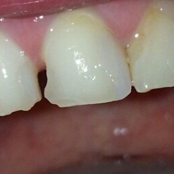Stempora Dental Care - Pictures from 6 months after my top row of teeth were "fixed" - Periodontists Near Me - Woodridge, Illinois