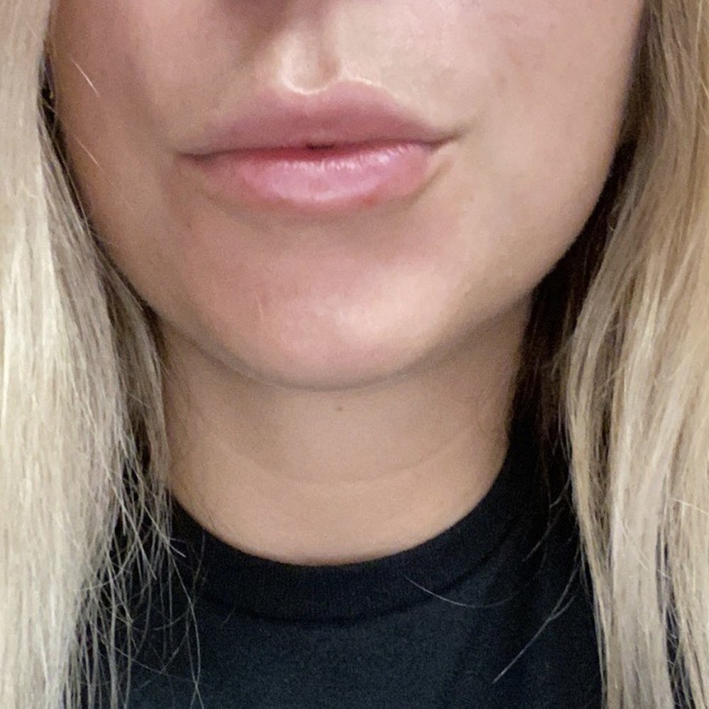 LaserAway - Lips by Angie (lips after 1 syringe) - Medical Spas Near Me - Costa Mesa, California LaserAway - Lips by Angie (lips after 1 syringe) - Medical Spas Near Me - Costa Mesa, California