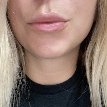 LaserAway - Lips by Angie (lips after 1 syringe) - Medical Spas Near Me - Costa Mesa, California LaserAway - Lips by Angie (lips after 1 syringe) - Medical Spas Near Me - Costa Mesa, California