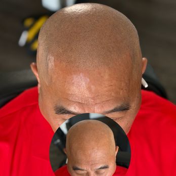 Scalp Micro Pigmentation - Noorwood scale 7 Scalp Micropigmentation SMP by Joe V. Nguyen - Hair Loss Centers Near Me - San Lorenzo, California Scalp Micro Pigmentation - Noorwood scale 7 Scalp Micropigmentation SMP by Joe V. Nguyen - Hair Loss Centers Near Me - San Lorenzo, California