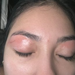 The burnt feels horrible & looks pretty bad.