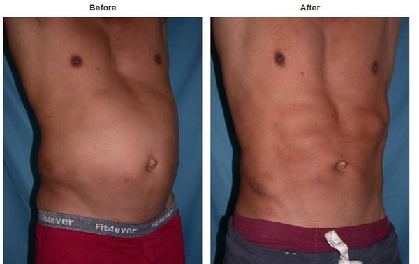 Photo of Suzanne Quardt MD - Palm Desert Plastic Surgery - Rancho Mirage, CA, US. Plastic Surgery Before & After Pictures https://palmdesertplasticsurgery.com/photo-gallery/