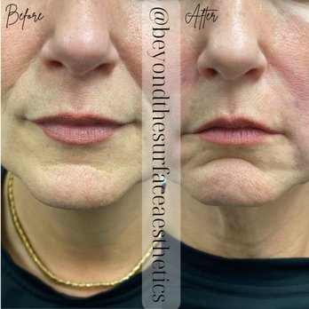 Beyond the Surface - Biofiller to nasolabial folds - Aestheticians Near Me - Edgewater, New Jersey Beyond the Surface - Biofiller to nasolabial folds - Aestheticians Near Me - Edgewater, New Jersey