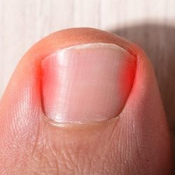 Karen Lee, DPM - Podiatric Associates Foot & Ankle Center - Don't live with painful ingrown nails!!!