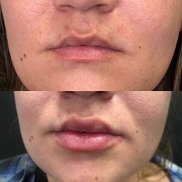 Lip fillers by Lucy Lip fillers by Lucy