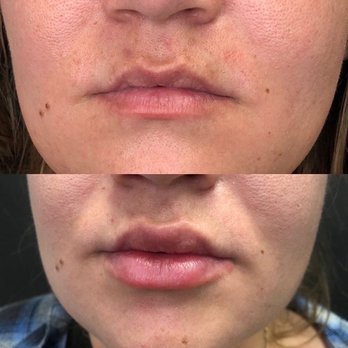 Synergy Medical Aesthetics - Lip fillers by Lucy - Skin Care Near Me - Upland, California Synergy Medical Aesthetics - Lip fillers by Lucy - Skin Care Near Me - Upland, California