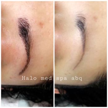 Halo Med Spa - Pre and post ! - Skin Care Near Me - Albuquerque, New Mexico Halo Med Spa - Pre and post ! - Skin Care Near Me - Albuquerque, New Mexico