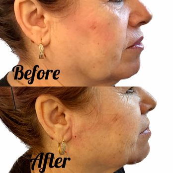 Vitality PDX - Before and after from filler for treatment of jowls. - Aestheticians Near Me Vitality PDX - Before and after from filler for treatment of jowls. - Aestheticians Near Me