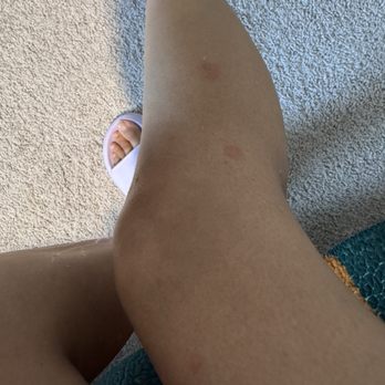 Grand Wailea, A Waldorf Astoria Resort - Bed bug bites from hotel - Hotels Near Me - Wailea, Hawaii